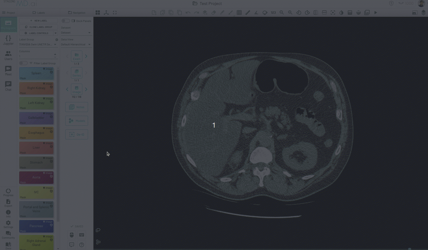 auto-segment-kidney.gif