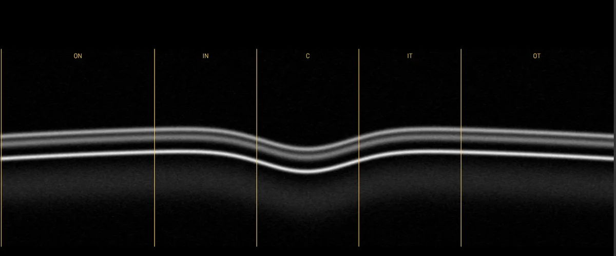 B-scan through the fovea