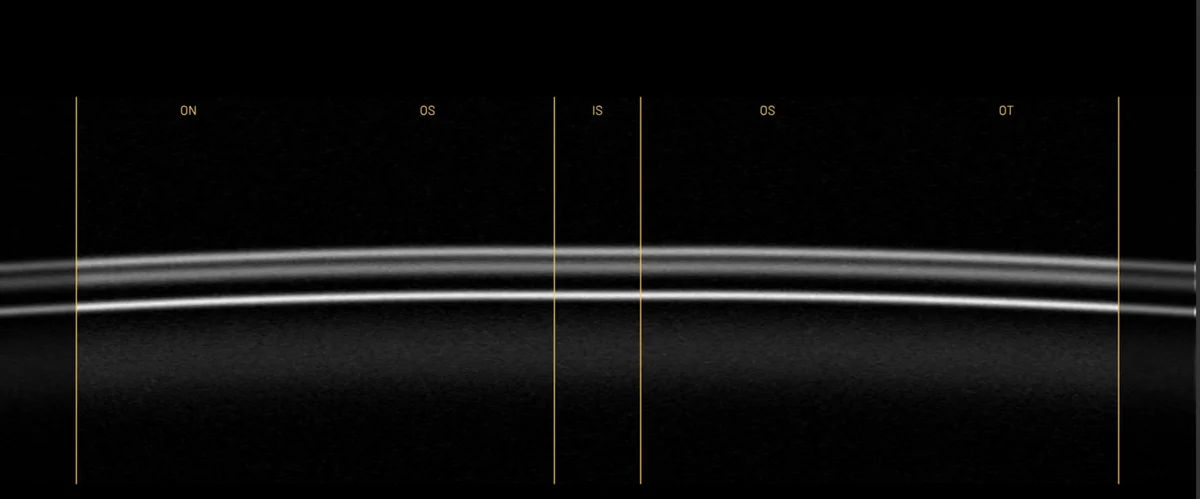 B-scan through the inner ring